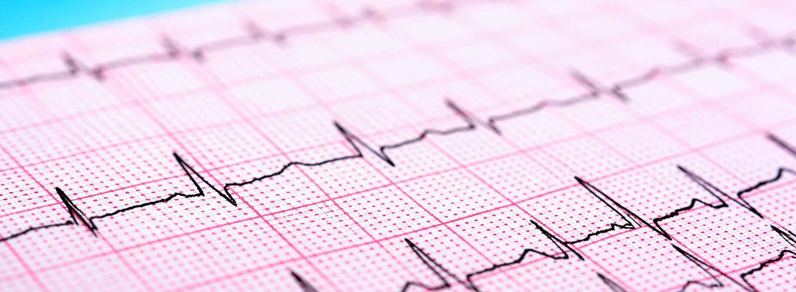 ecg-waveforms
