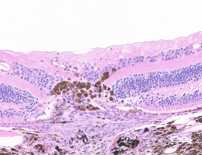 Laser CV Lesions 2 - Ophthalmology 